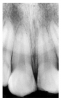 Figure 21 - Fractured Incisal Edges