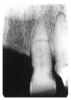 Figure 22 - Fractured Root