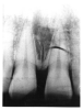 Figure 23 - Fingernail Crimp on Radiographic image
