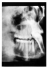 Figure 24 - Non-displaced Mandibular Fracture