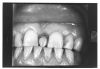 Figure 26 - Mesioden