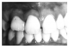 Figure 29 - Maxillary Right Lateral Incisor Macrodont