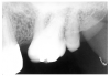 Figure 31 - Maxillary Third Molar Microdont