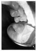 Figure 33 - Maxillary Premolar with Evagination