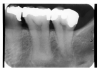 Figure 36 - Pyramidal in #18; Taurodontism in #19