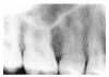 Figure 39 - Supernumerary Roots