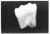 Figure 40 - Fusion or Gemination