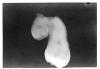 Figure 42 - Radiographic Concrescence