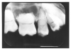 Figure 45 - Radicular Dentin Dysplasia