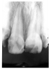 Figure 47 - Amelogenesis Imperfecta