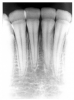 Figure 49 - Generalized Environmental Enamel Hypoplasia