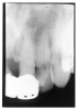 Figure 51 - Radiographic Talon Cusp