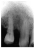 Figure 52 - Abrasion