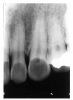 Figure 53 - Erosion