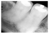 Figure 55 - Hypercementosis