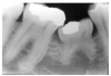 Figure 56 - Deciduous Ankylosis