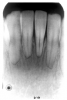 Figure 57 - External Resorption