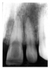 Figure 58 - Internal Resorption