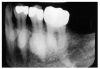 Figure 59 – Radiographic image of Mandibular Tori