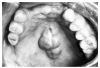 Figure 60 - Maxillary Torus