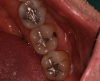 Fig 1. Amalgam restoration. Courtesy of Dentalcare.com.