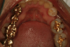 Fig 2. Example of gold inlay and gold onlay. Courtesy of Dentalcare.com.