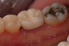 Fig 3. Porcelain fused to metal crown. Courtesy of Dentalcare.com.