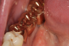 Fig 5. Gold bridge. Courtesy of Dentalcare.com.