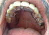 Fig 6. Removable partial denture. Courtesy of Dentalcare.com.