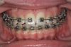 Fig 7. Example of orthodontic treatment. Courtesy of Dentalcare.com.