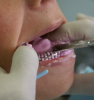 Holding Tray in Place (Courtesy of Dux Dental)