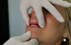Placing Bite Wax in Mouth (Courtesy of Dux Dental)