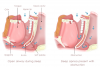 Figure 1. Depiction of Airway Obstruction