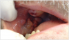 Figure 2. Example of Oral Cancer - courtesy of dentalcare.com