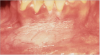 Figure 3. Snuff-Related Keratosis - courtesy of dentalcare.com