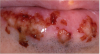Figure 4. Cheilosis Related to Acute Sun Damage - courtesy of dentalcare.com