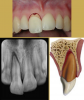 Fig 4. Images of Extrusion