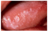 Figure 6- Leukoplakia Courtesy of Dentalcare.com