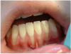 Figure 9 - Gingival recession Courtesy of Dentalcare.com