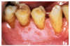 Figure 10 - Gingival irritation and tobacco stained teeth Courtesy of Dentalcare.com