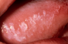 Figure 3. Leukoplakia Courtesy of Dentalcare.com