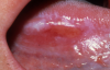 Figure 4. Erythroplakia Courtesy of Dentalcare.com