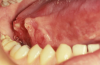 Figure 5. Squamous Cell Carcinoma Courtesy of Dentalcare.com