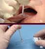 Figure 8 a. OralCDx® brush biopsy on a patient’s tongue b. Specimen obtained from the OralCDx® brush biopsy is sent to a laboratory for testing Copyright © Image courtesy of OralCDx®