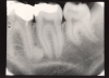 Figure 1 - Periapical Image