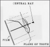 Figure 18 - Maxillary Canines