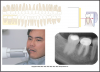 Figure 37 - Mandibular Molars