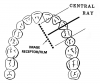 Figure 43 - Maxillary Canines