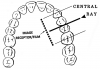 Figure 46 - Maxillary Premolars