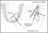 Figure 54 - Mandibular Canines